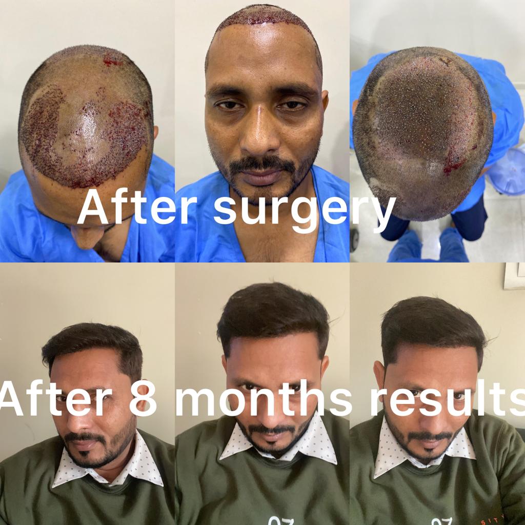 FUE Hair Transplant - DHT